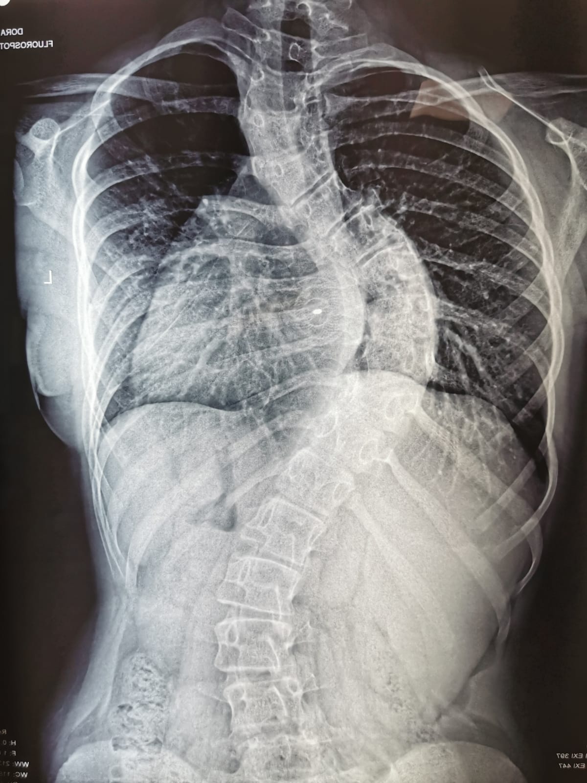radiografie coloana